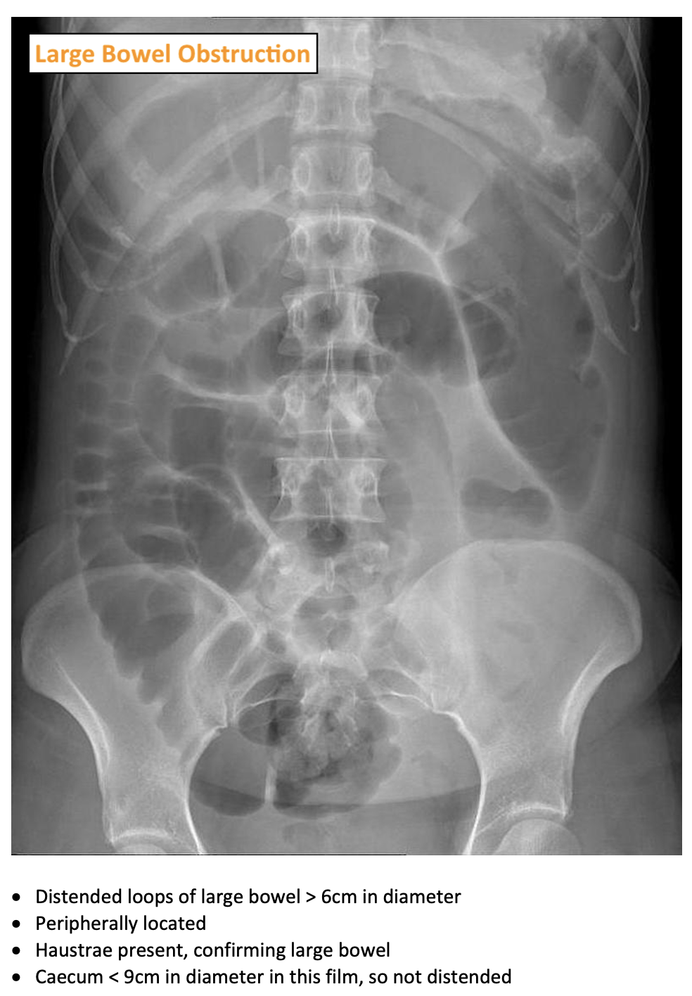 Bowel Obstruction On AXR