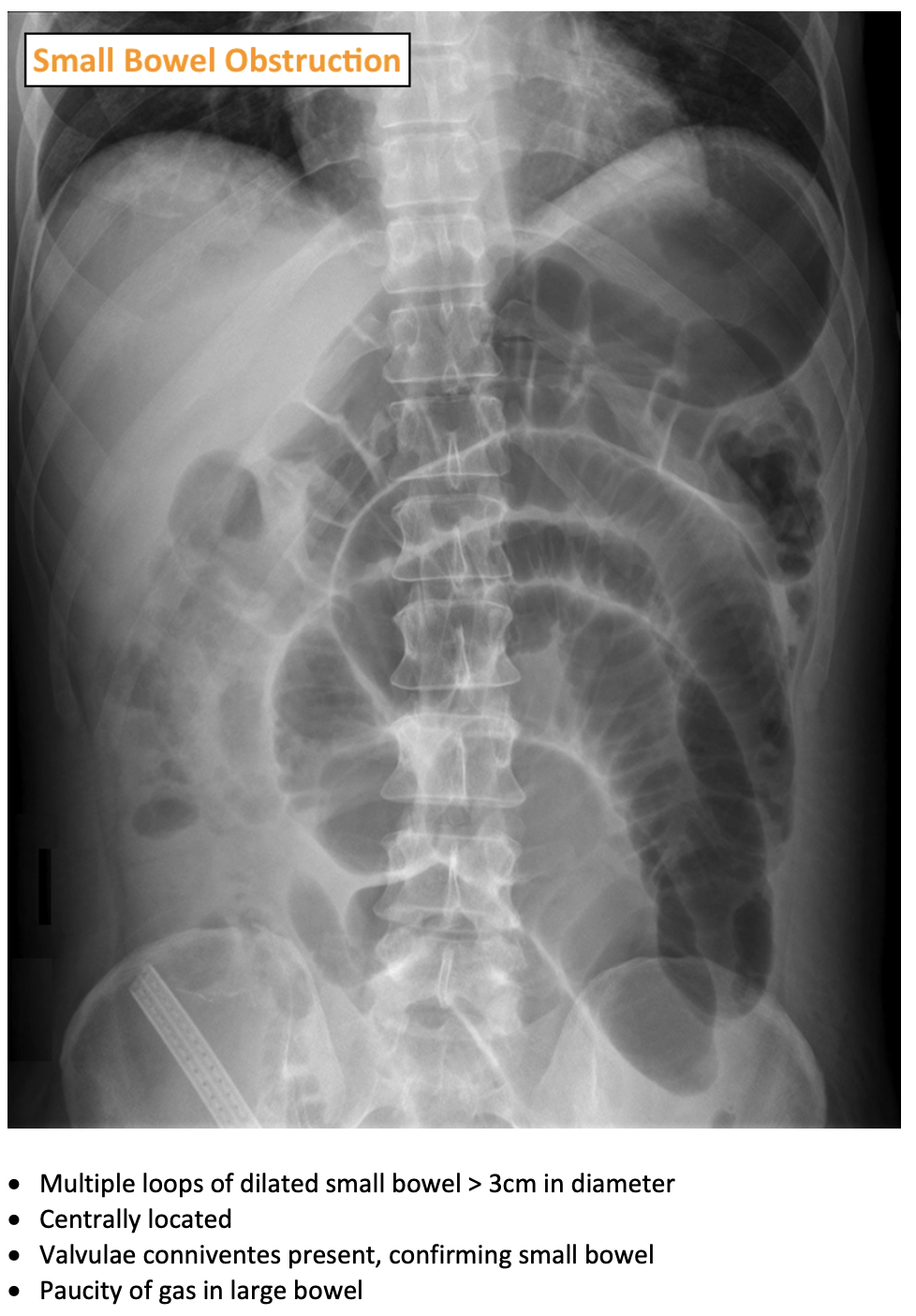 Bowel Obstruction On AXR