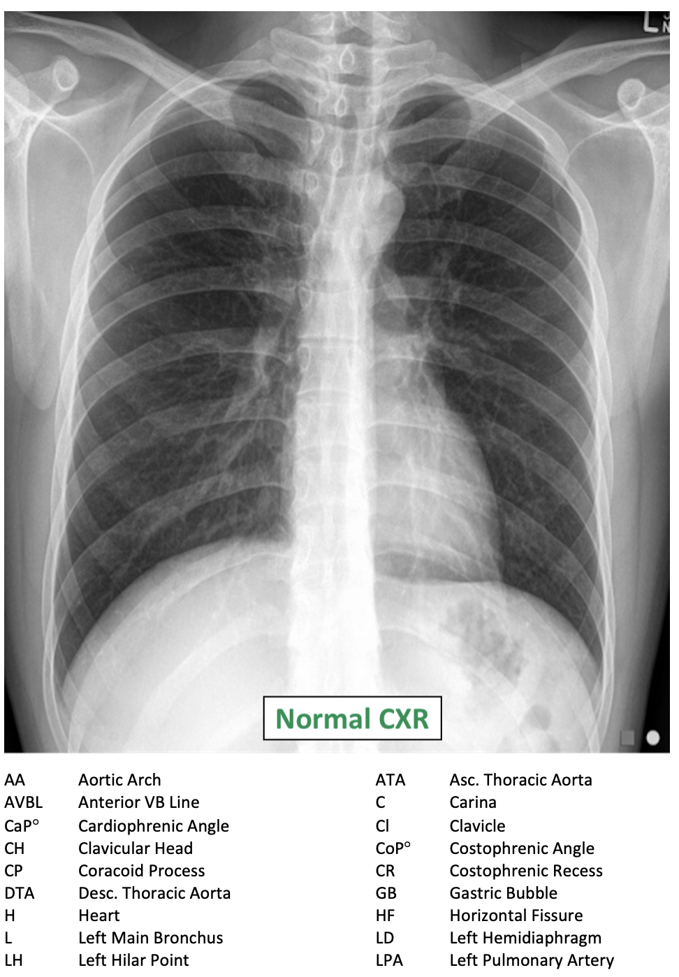 Chest XRay Interpretation