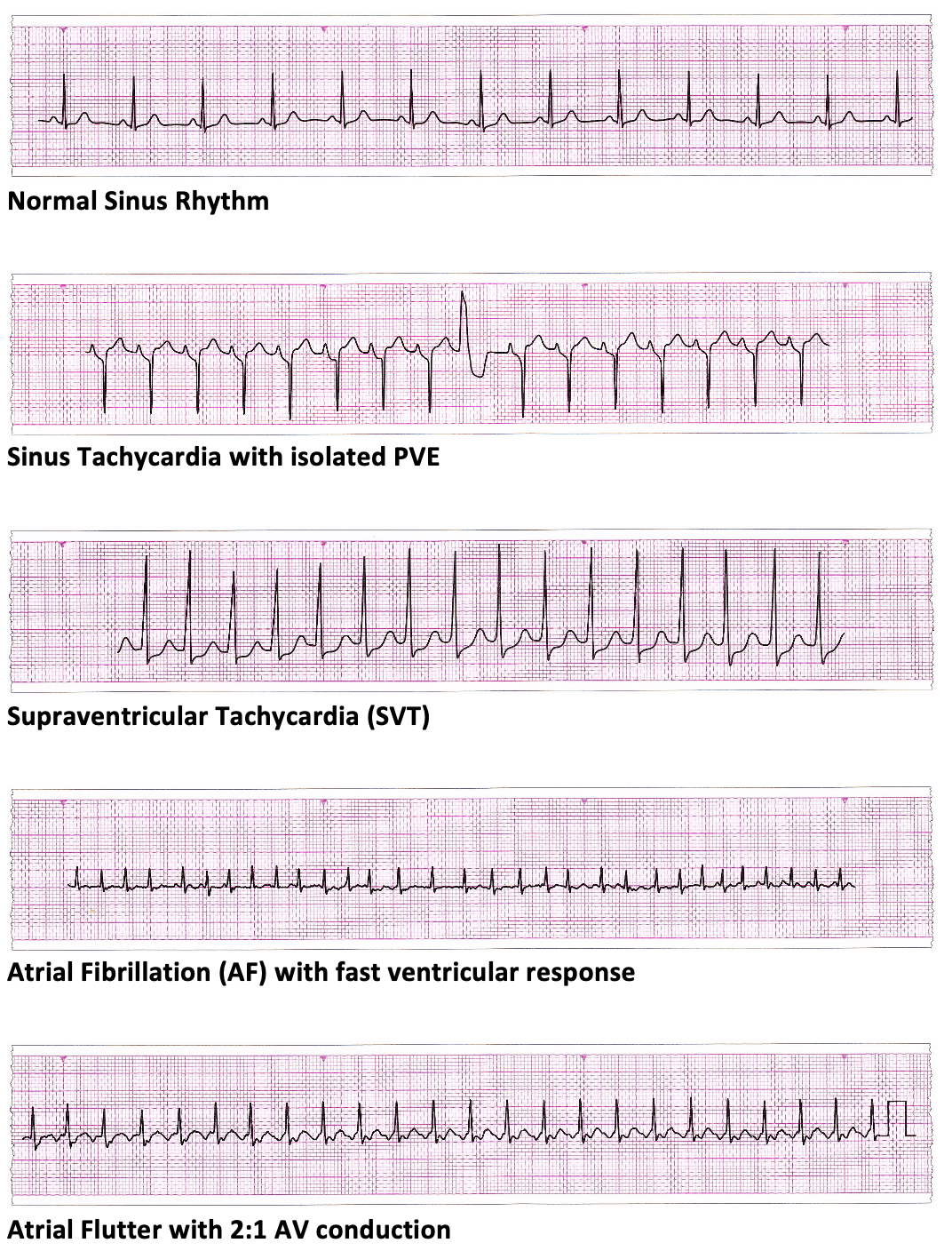 ECG