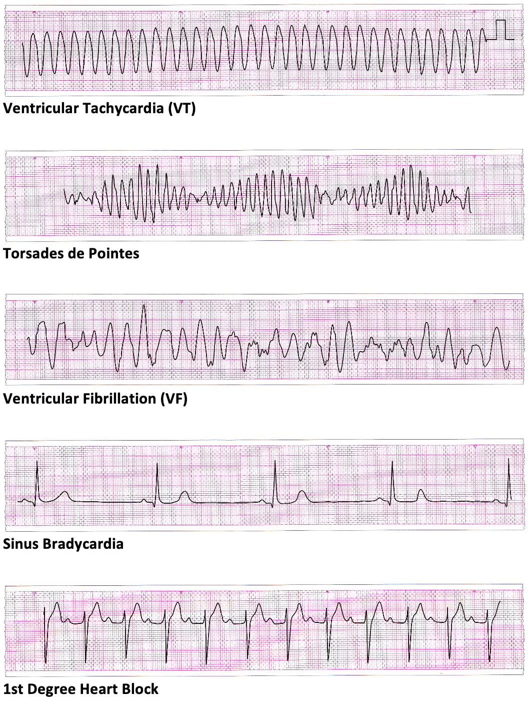 ECG