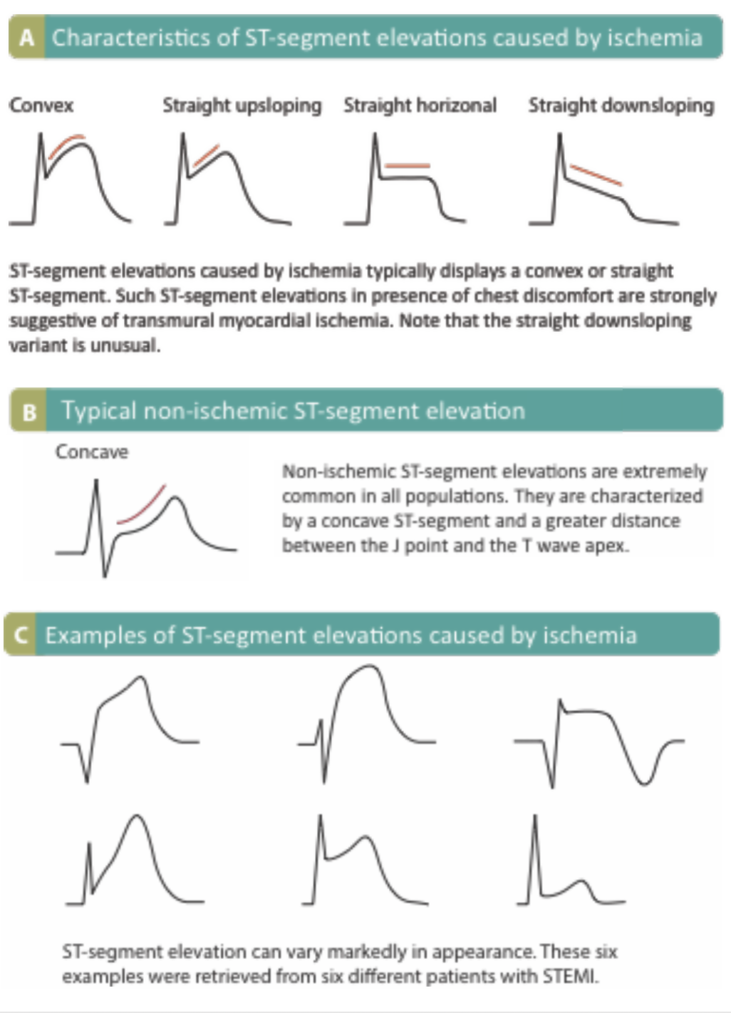 ST Segment and T Wave Abnormalities