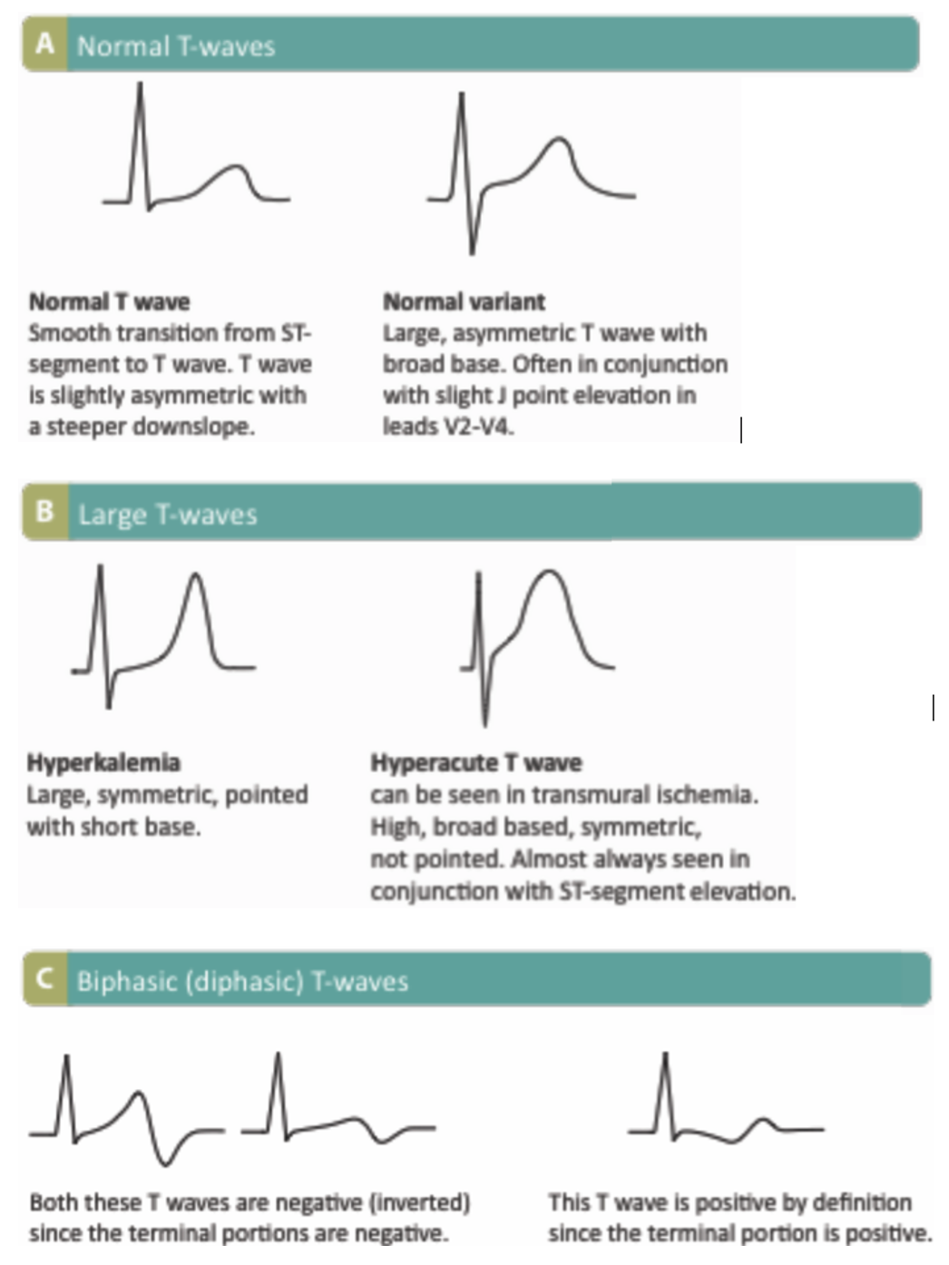 ST Segment and T Wave Abnormalities