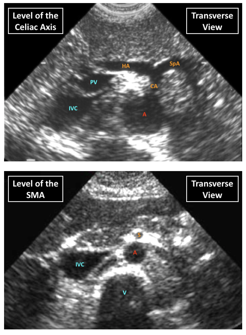 Ultrasound Of The Abdominal Aorta