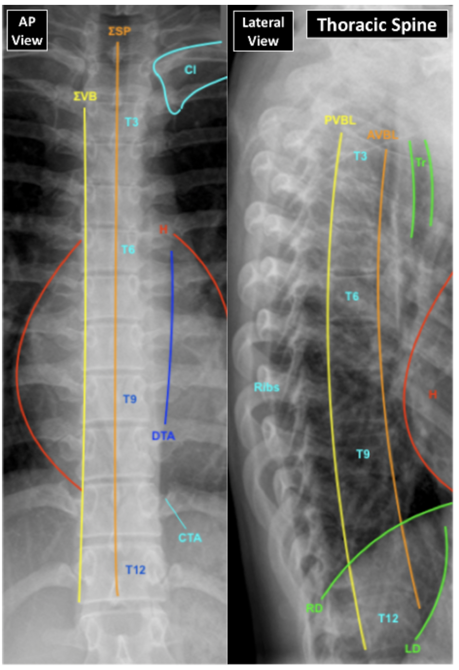 XR Chest & Thoracic Spine | EMcyclopedia