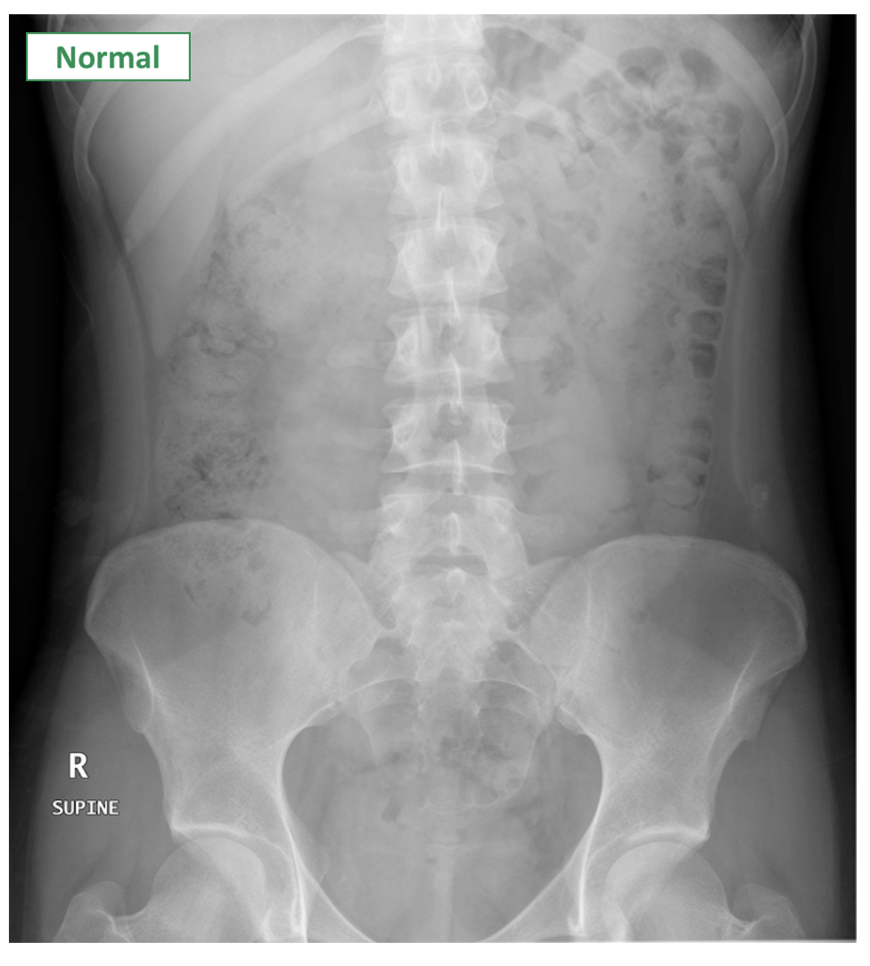 Abdominal XRay Interpretation