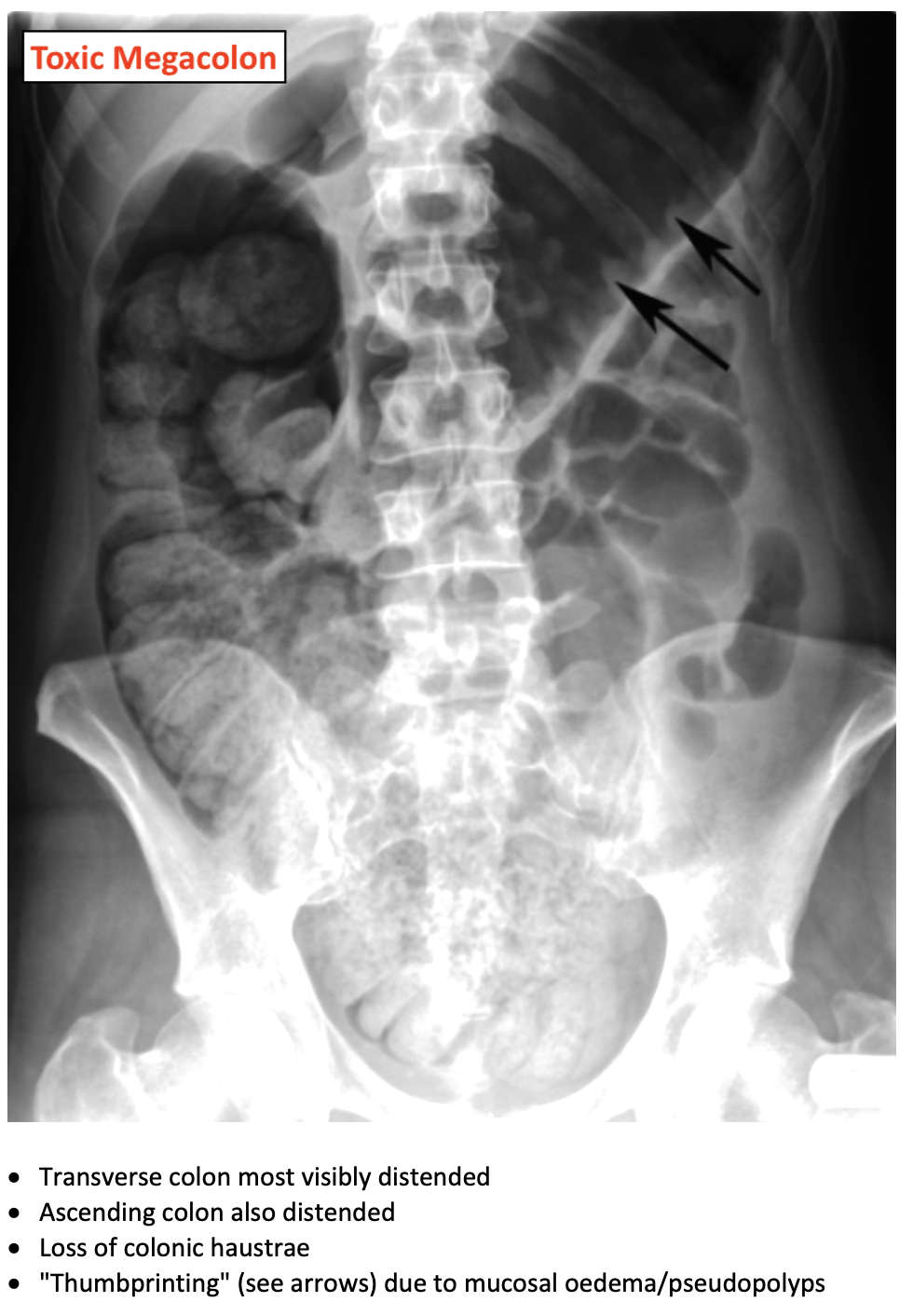 Acute Ulcerative Colitis And Toxic Megacolon On AXR