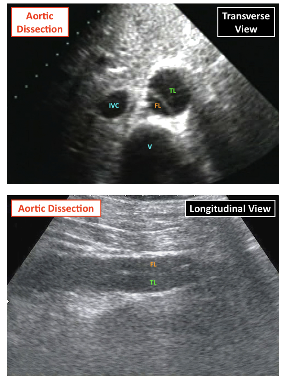 Abdominal Aortic Dissection On USS