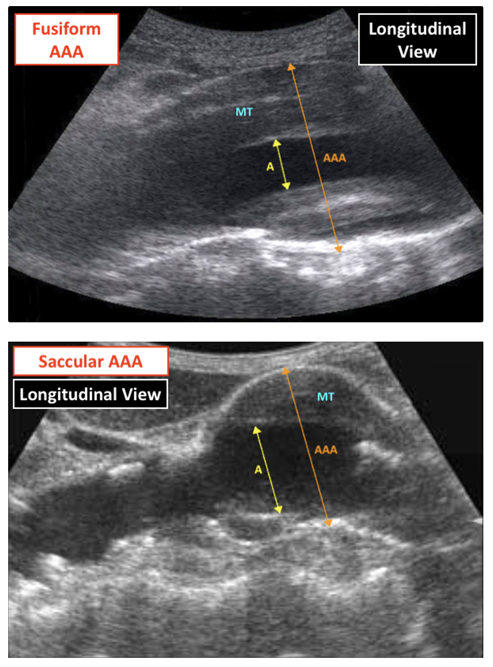 Alt tAbdominal Aortic Anneurysm On USSext