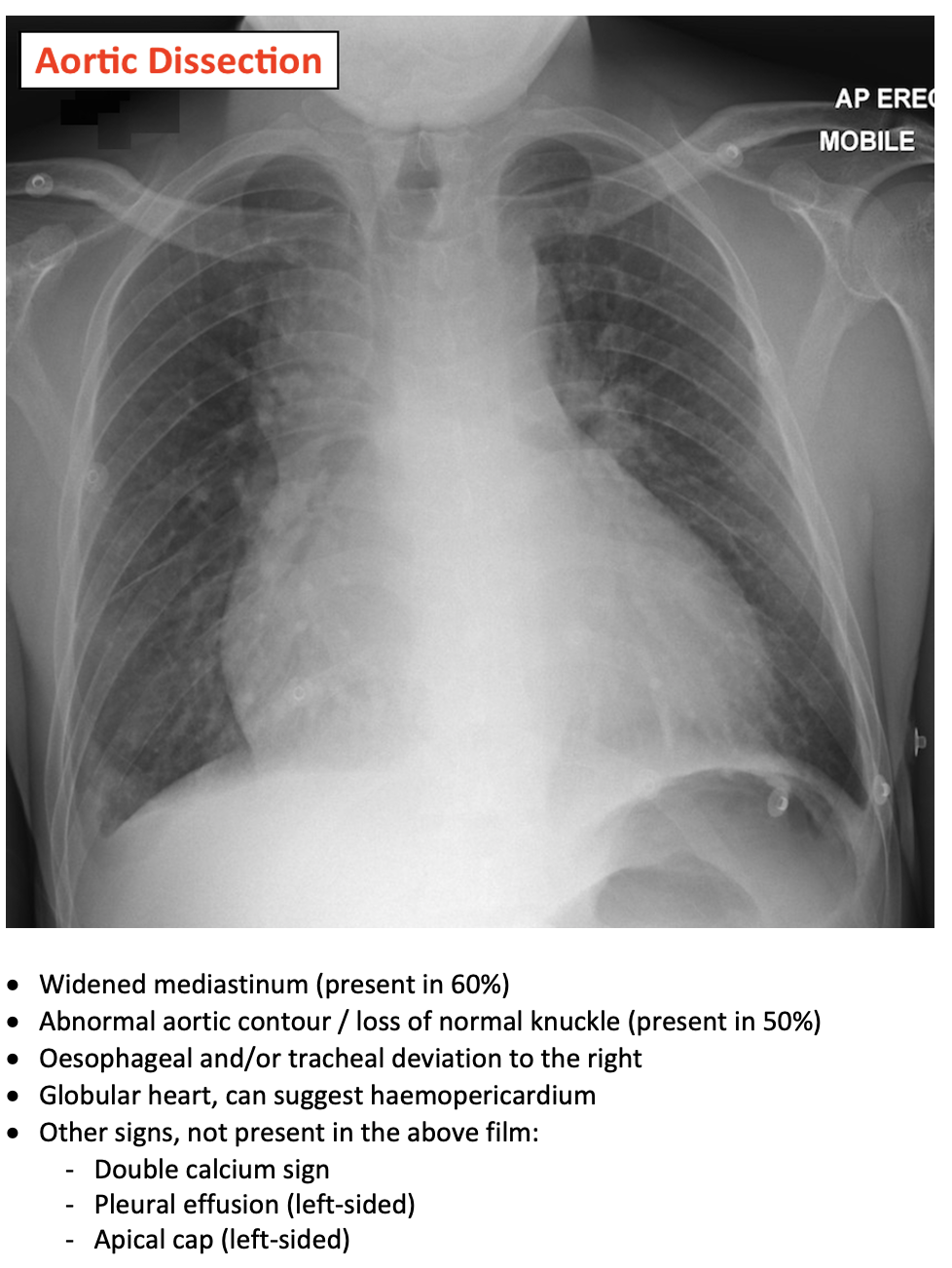 Aortic Dissection On CXR