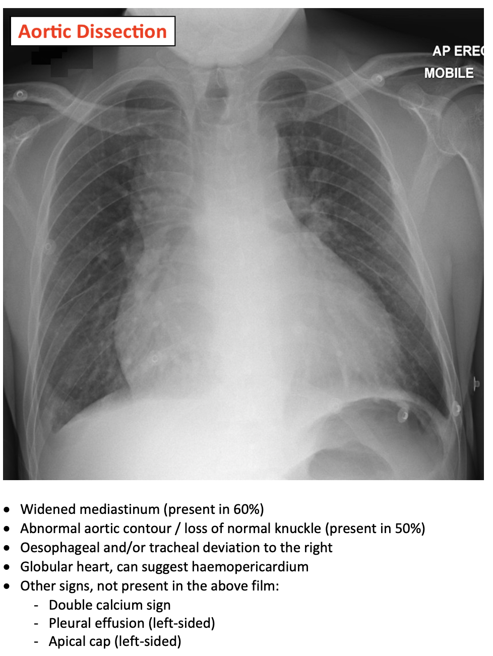 Thoracic Aortic Aneurysms On CXR EMcyclopedia Thoracic Aortic Aneurysms On CXR EMcyclopedia