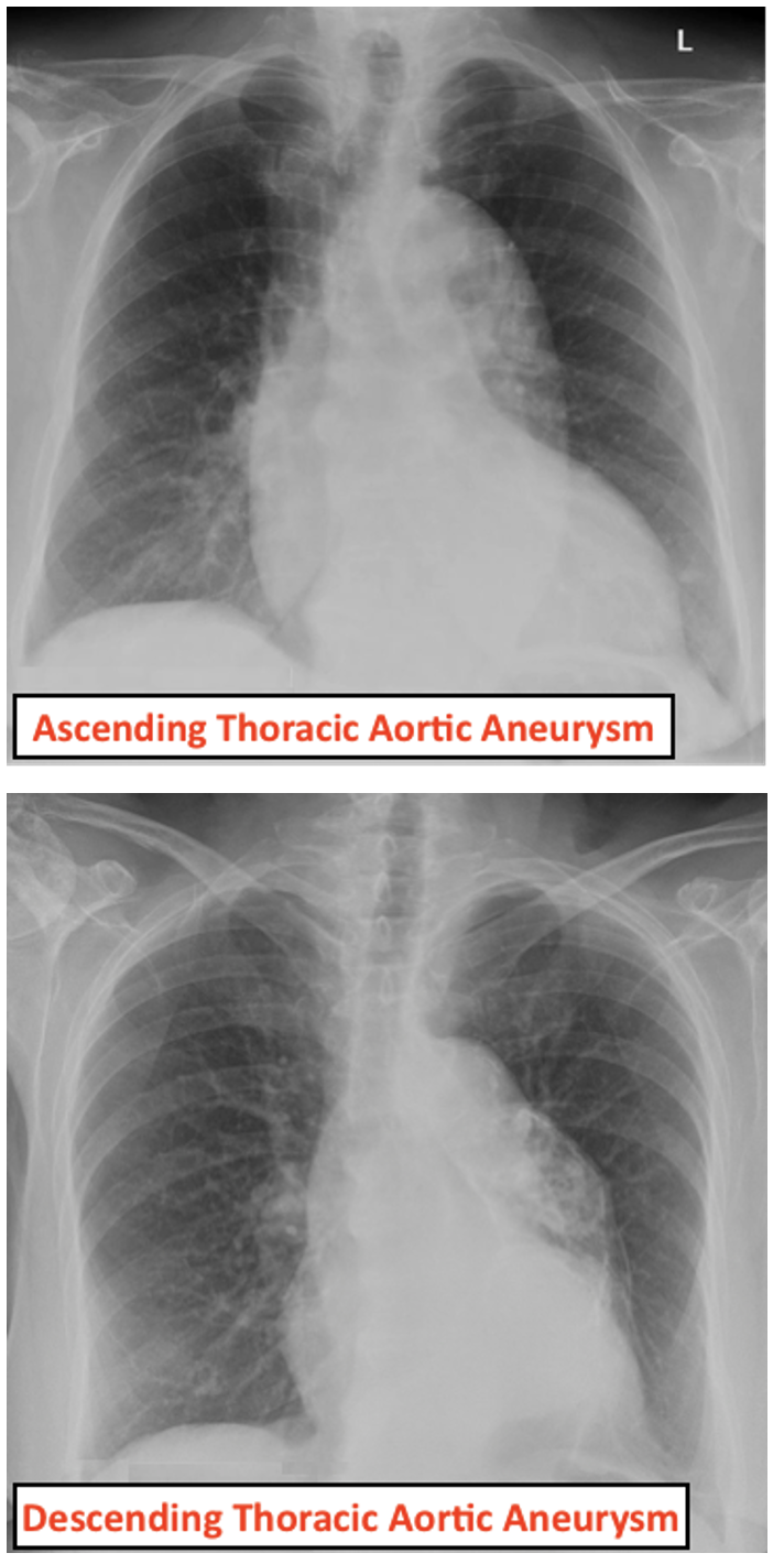 Thoracic Aortic Aneurysms on CXR