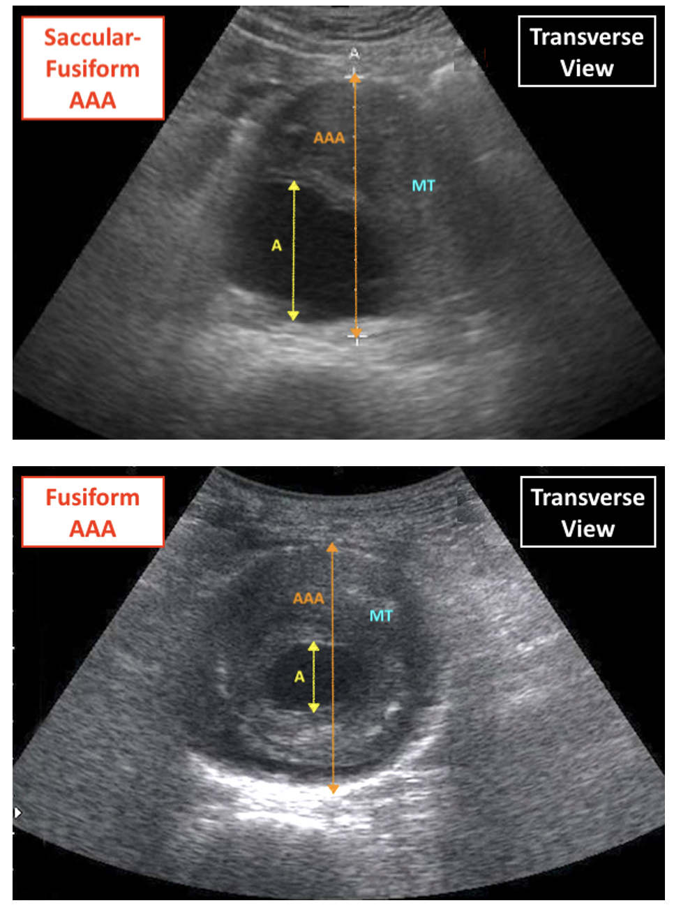 Alt Abdominal Aortic Anneurysm On USS