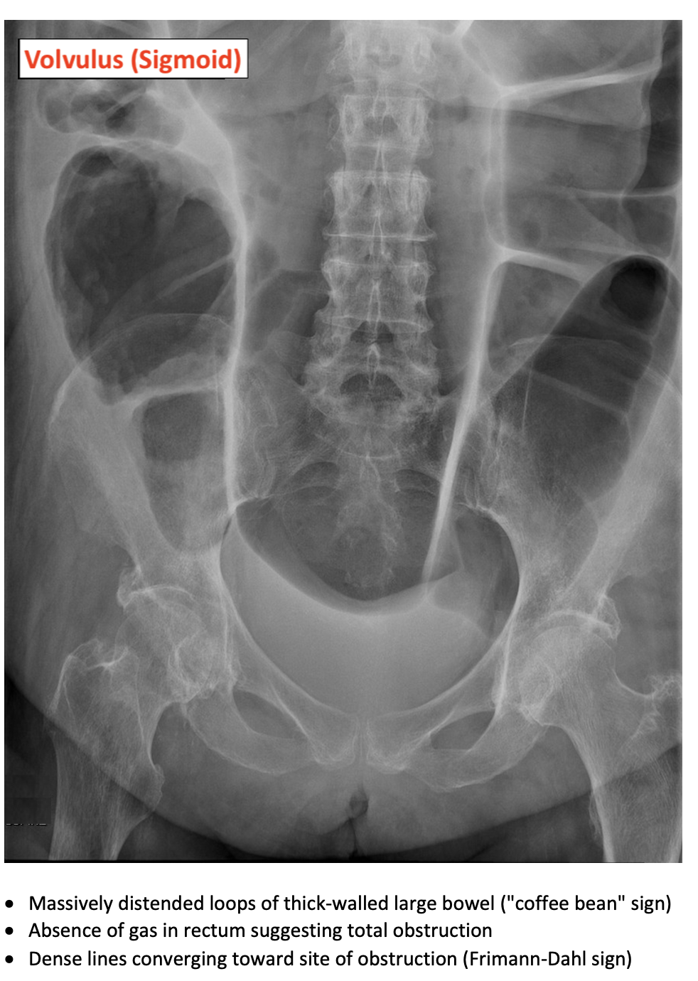 Bowel Obstruction On AXR