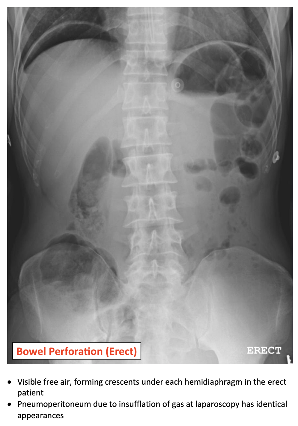 Bowel Perforation On AXR