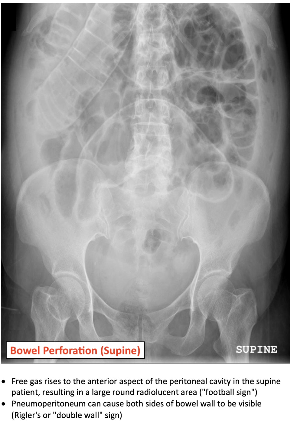 Bowel Perforation On AXR