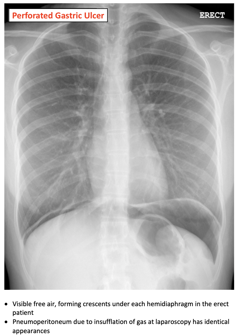 Bowel Perforation On CXR