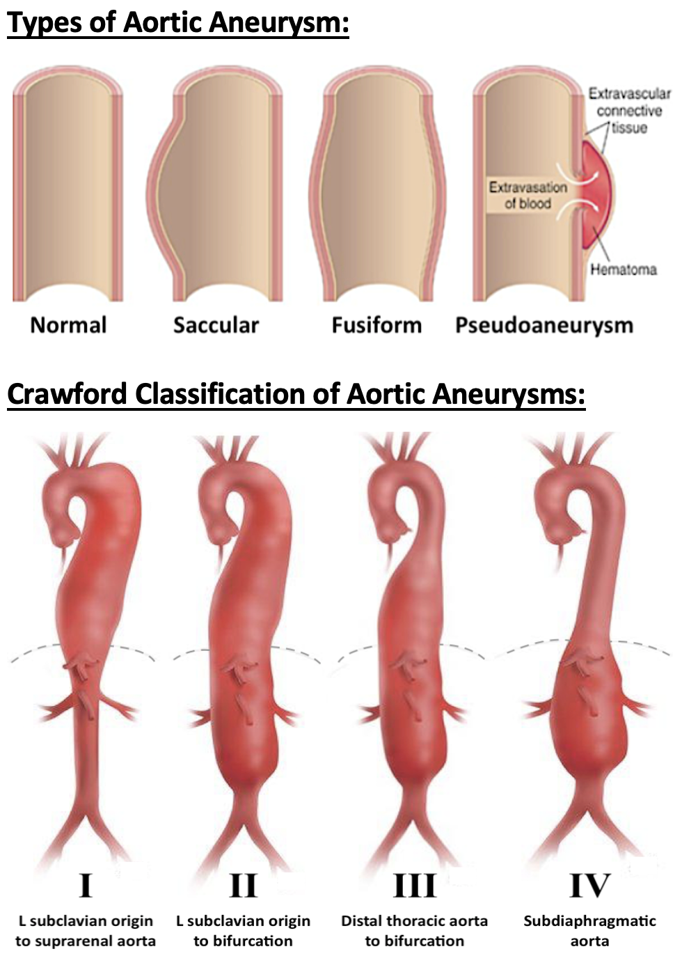 Classification Of Aortic Aneurysms