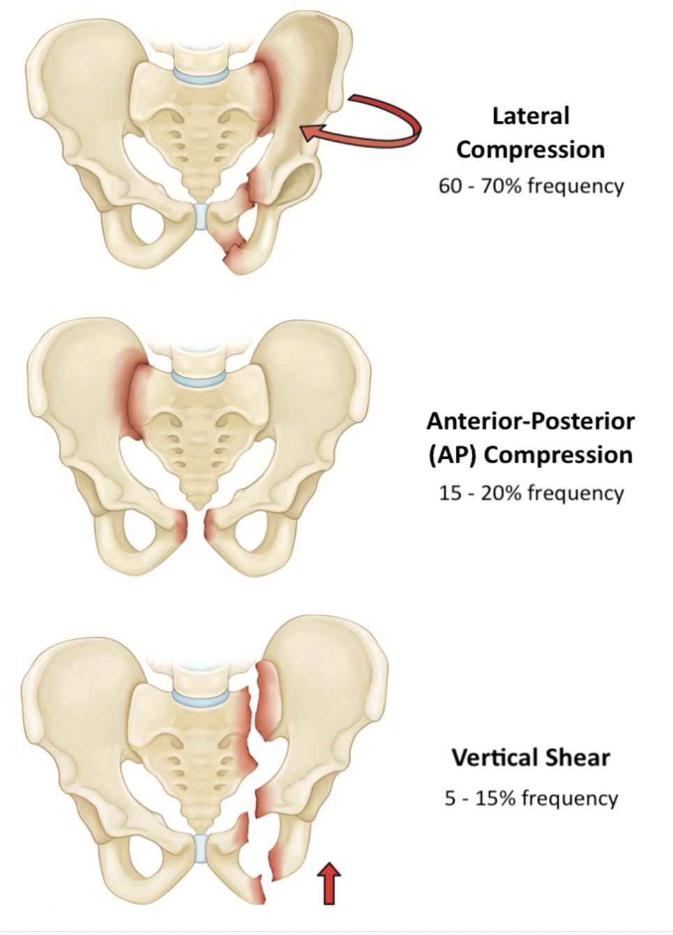 !Alt text(/public/T&O/classificationofunstablepelvic.png)