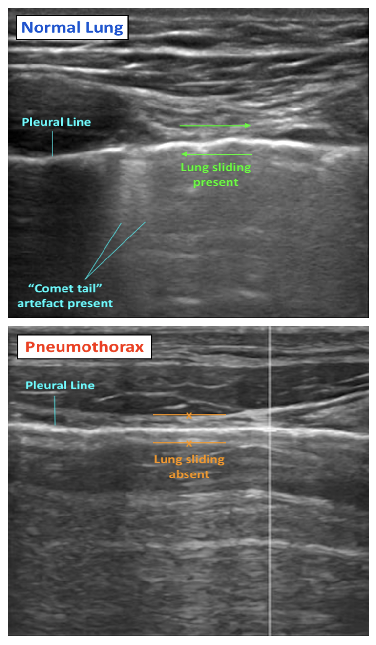 eFAST Scan Pneumothorax Detection