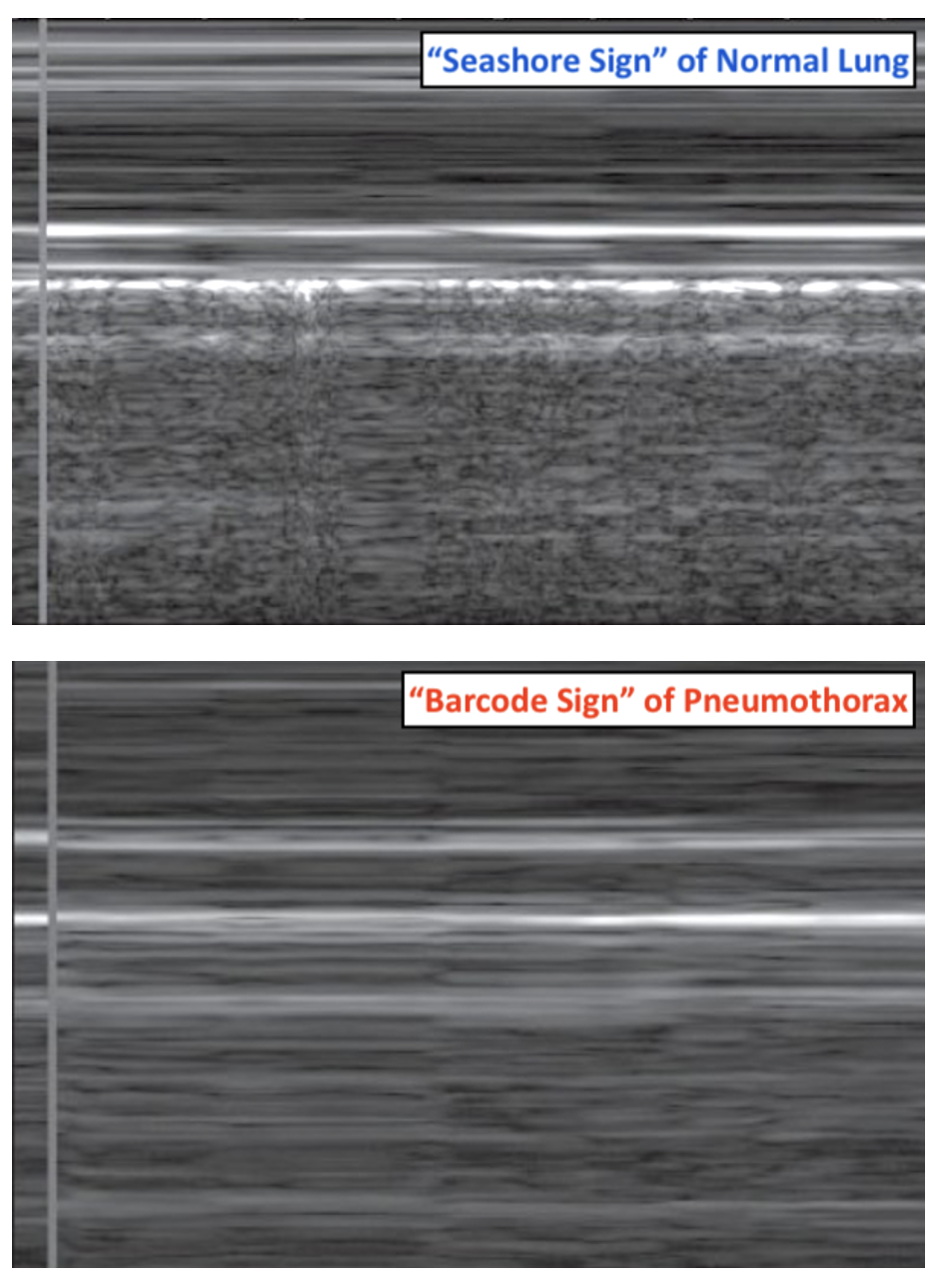 eFAST Scan Pneumothorax Detection