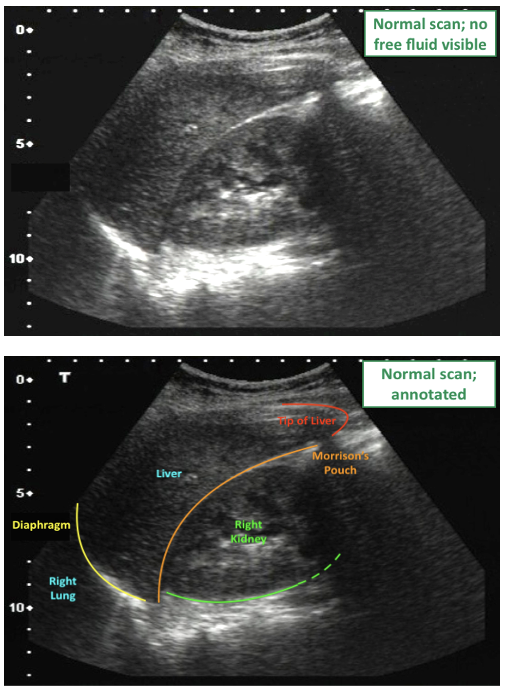 FAST Scan Hepatorenal Views