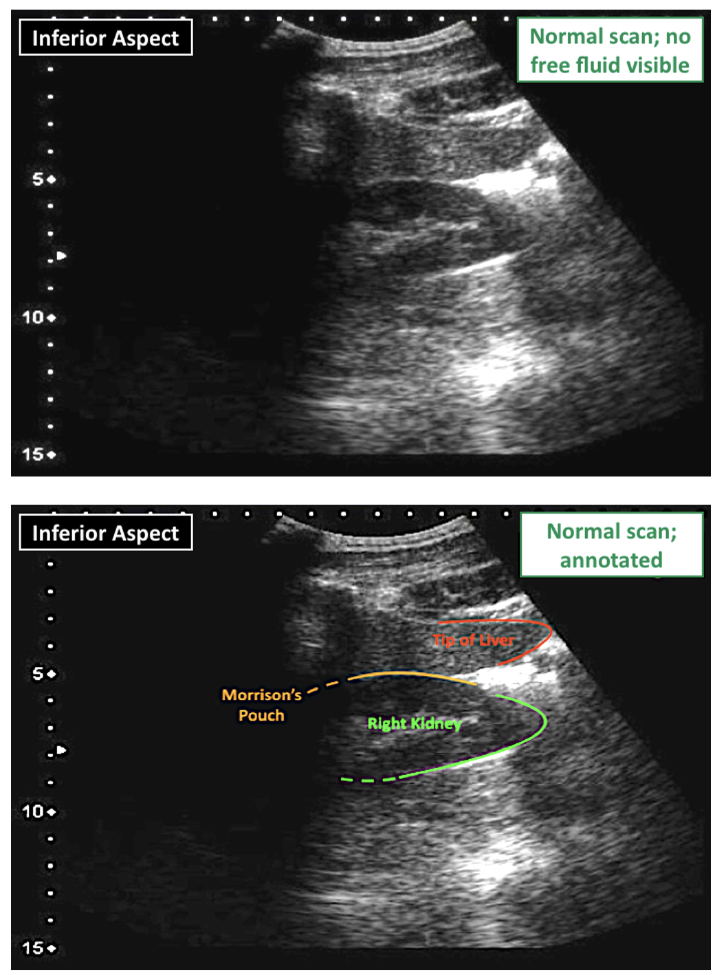 FAST Scan Hepatorenal Views