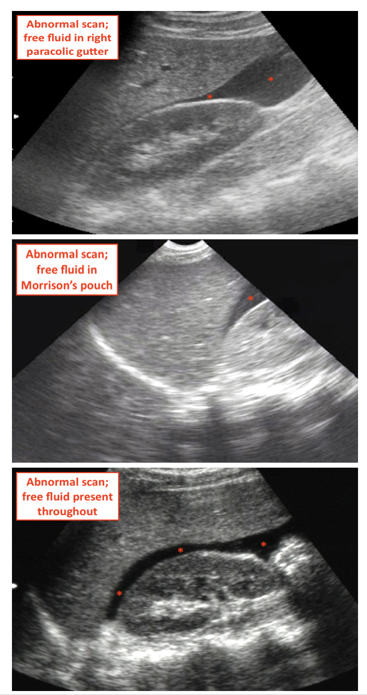 FAST Scan Hepatorenal Views