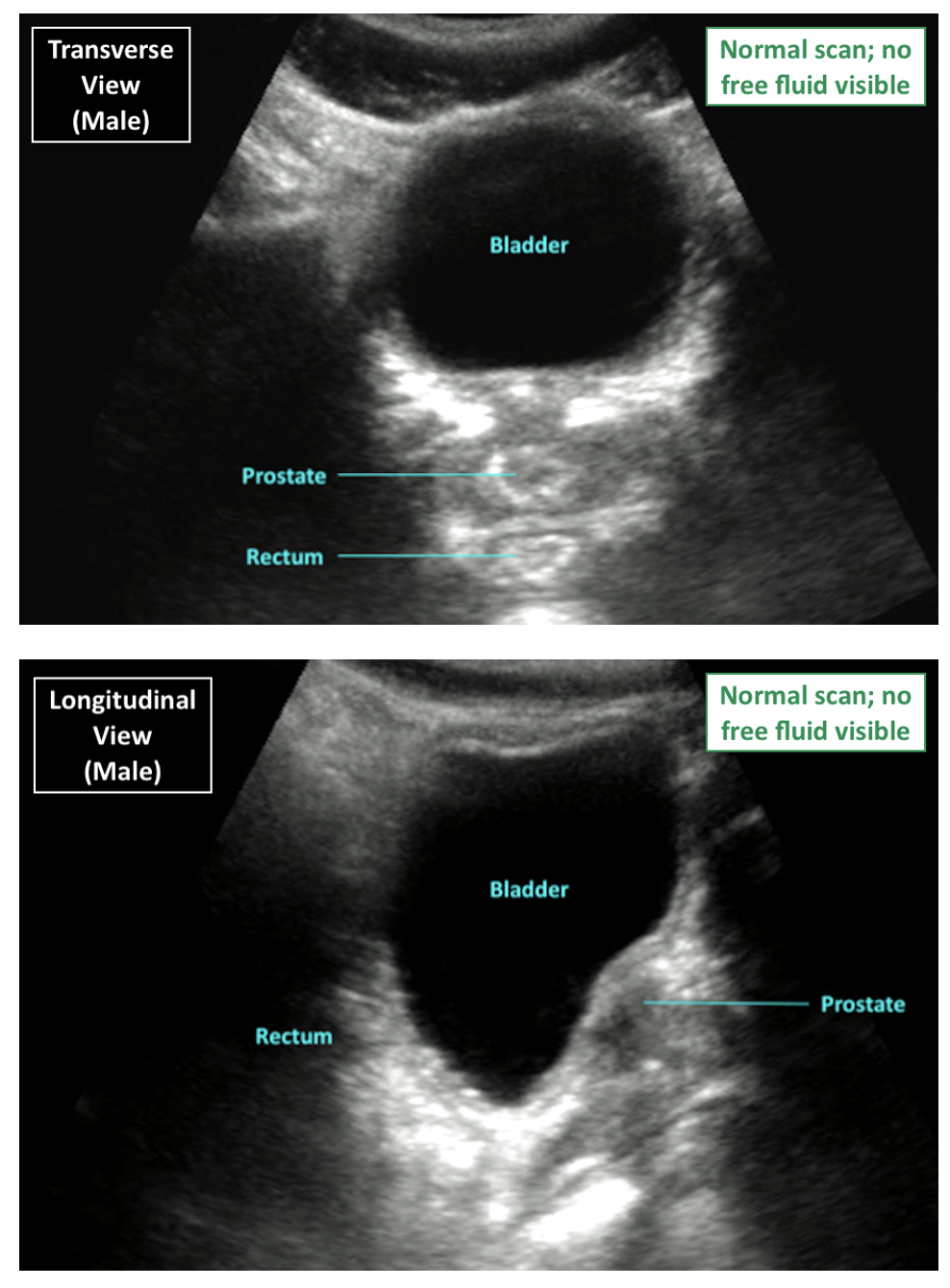 FAST Scan Pelvic View