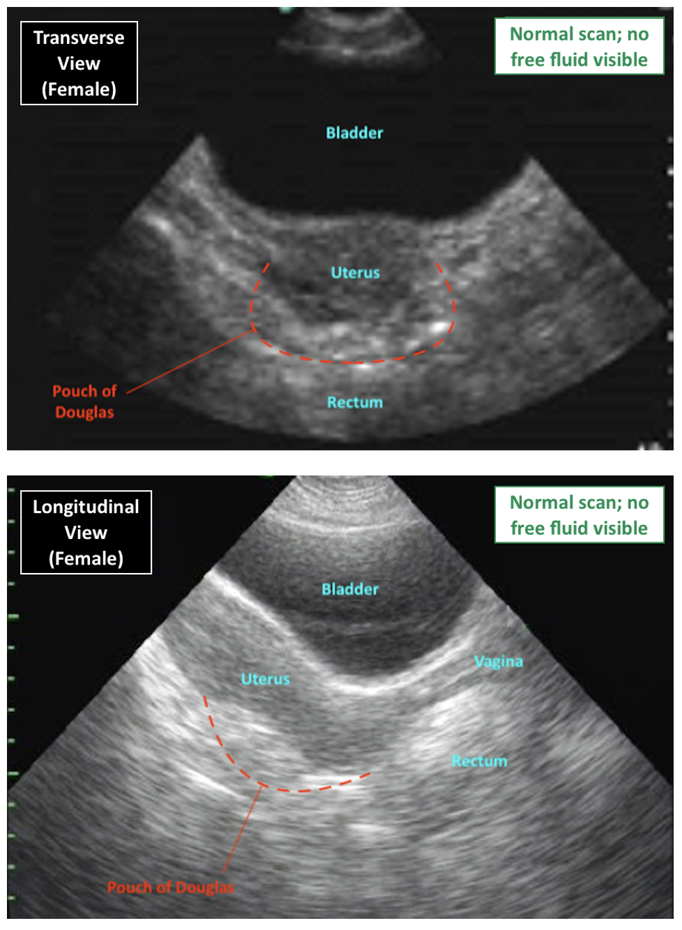 FAST Scan Pelvic View