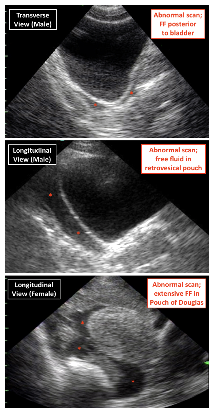 FAST Scan Pelvic View