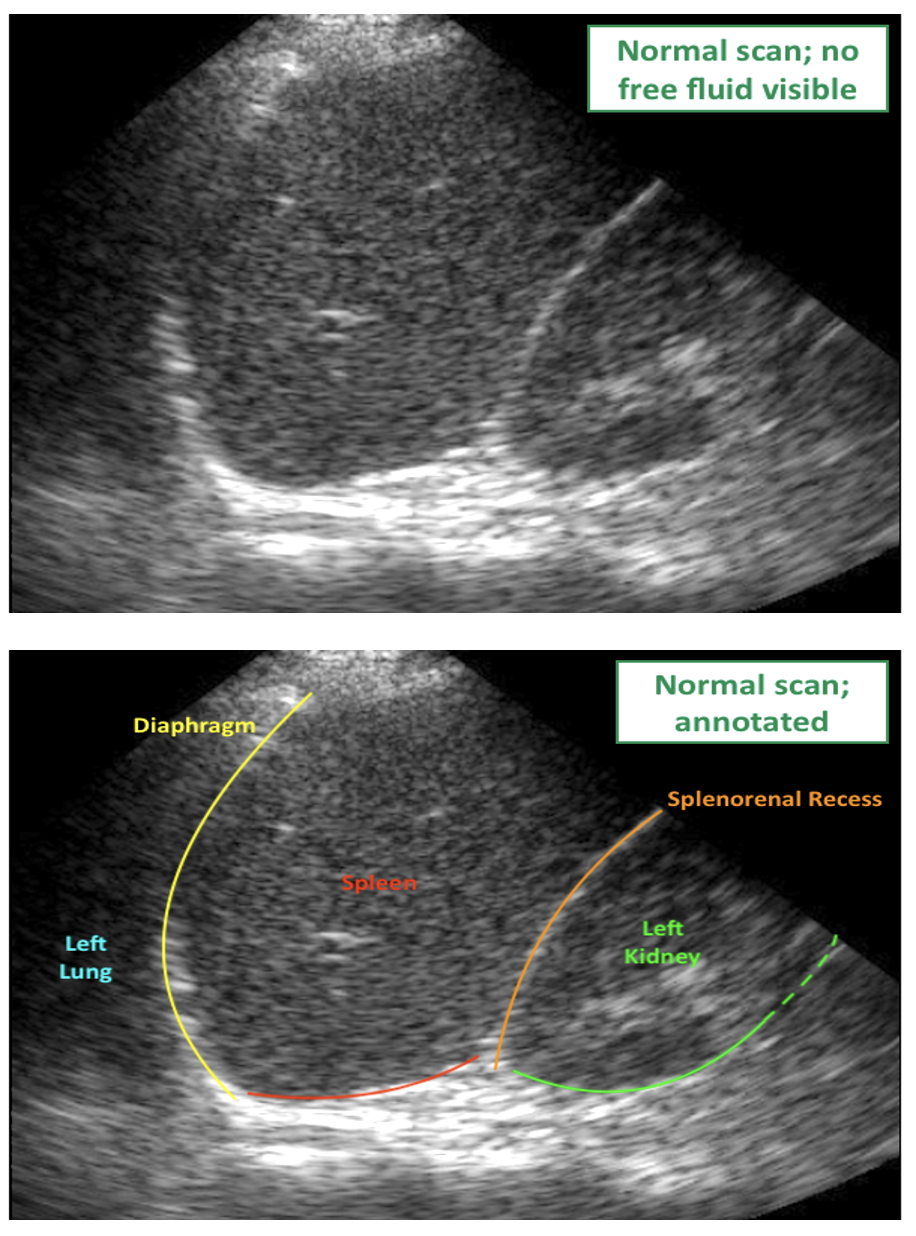 FAST Scan Splenorenal View