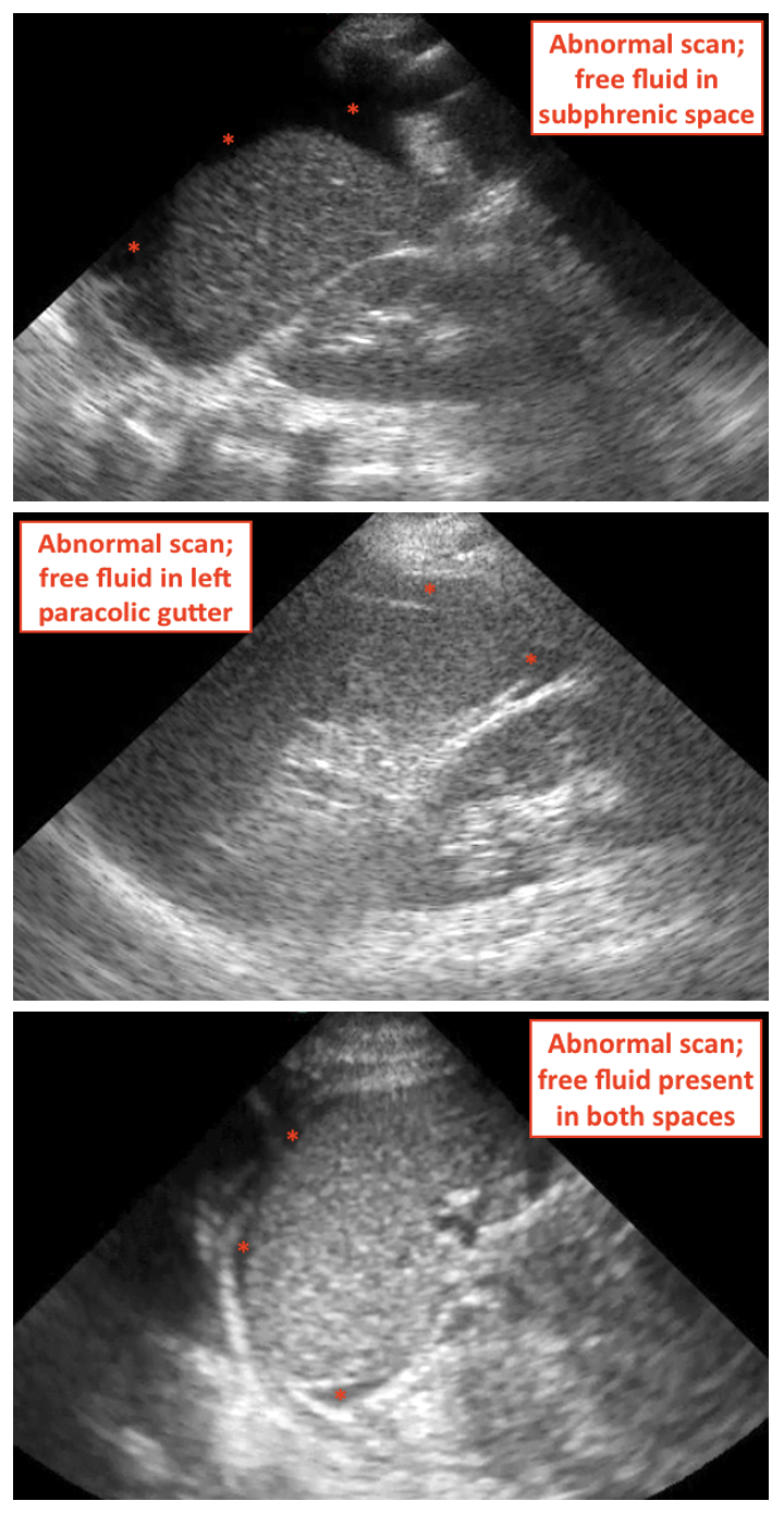 FAST Scan Splenorenal View