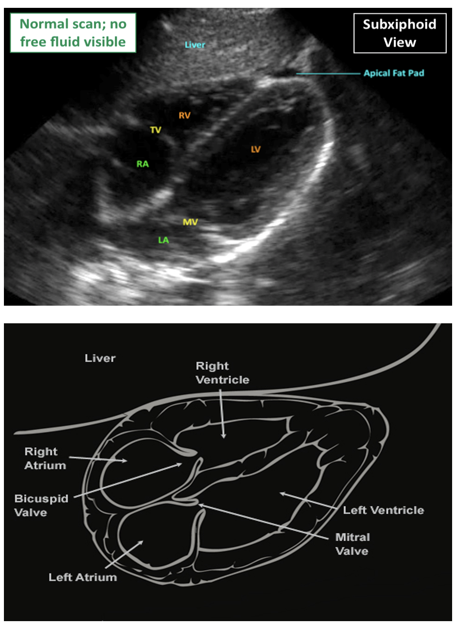 FAST Scan Subxiphoid Parasternal Long Axis Views