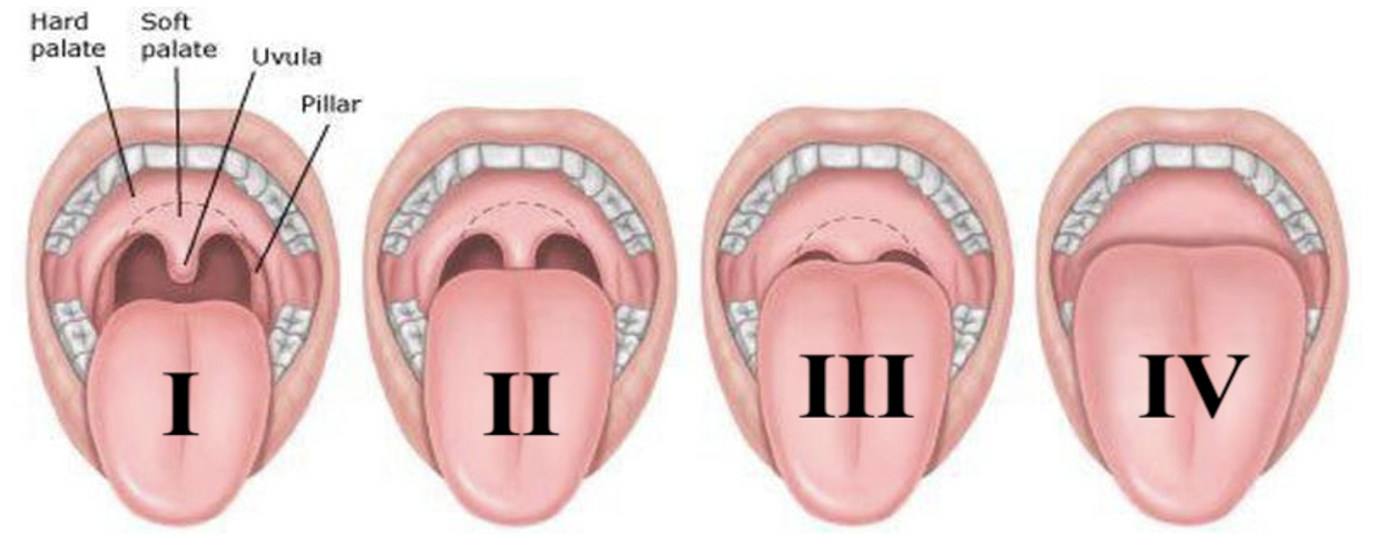 Modified Mallampatti Classification