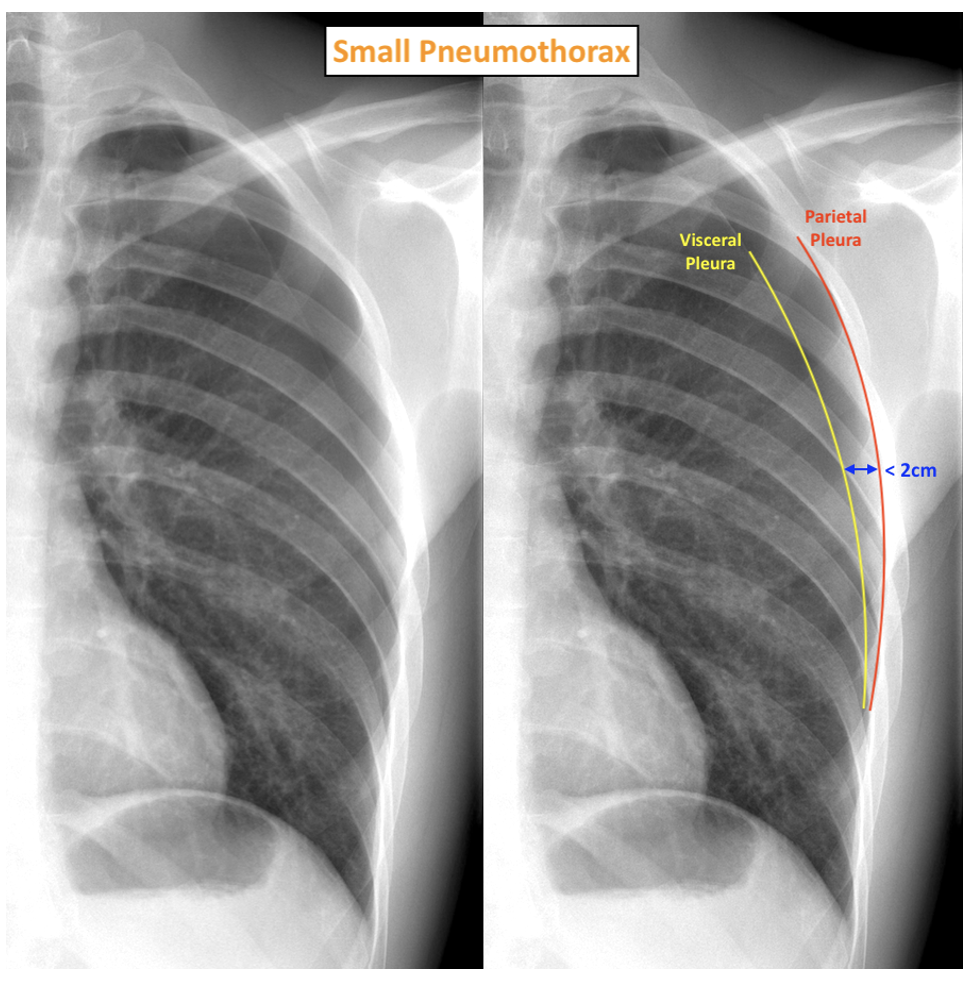 Pneumothoraces On CXR