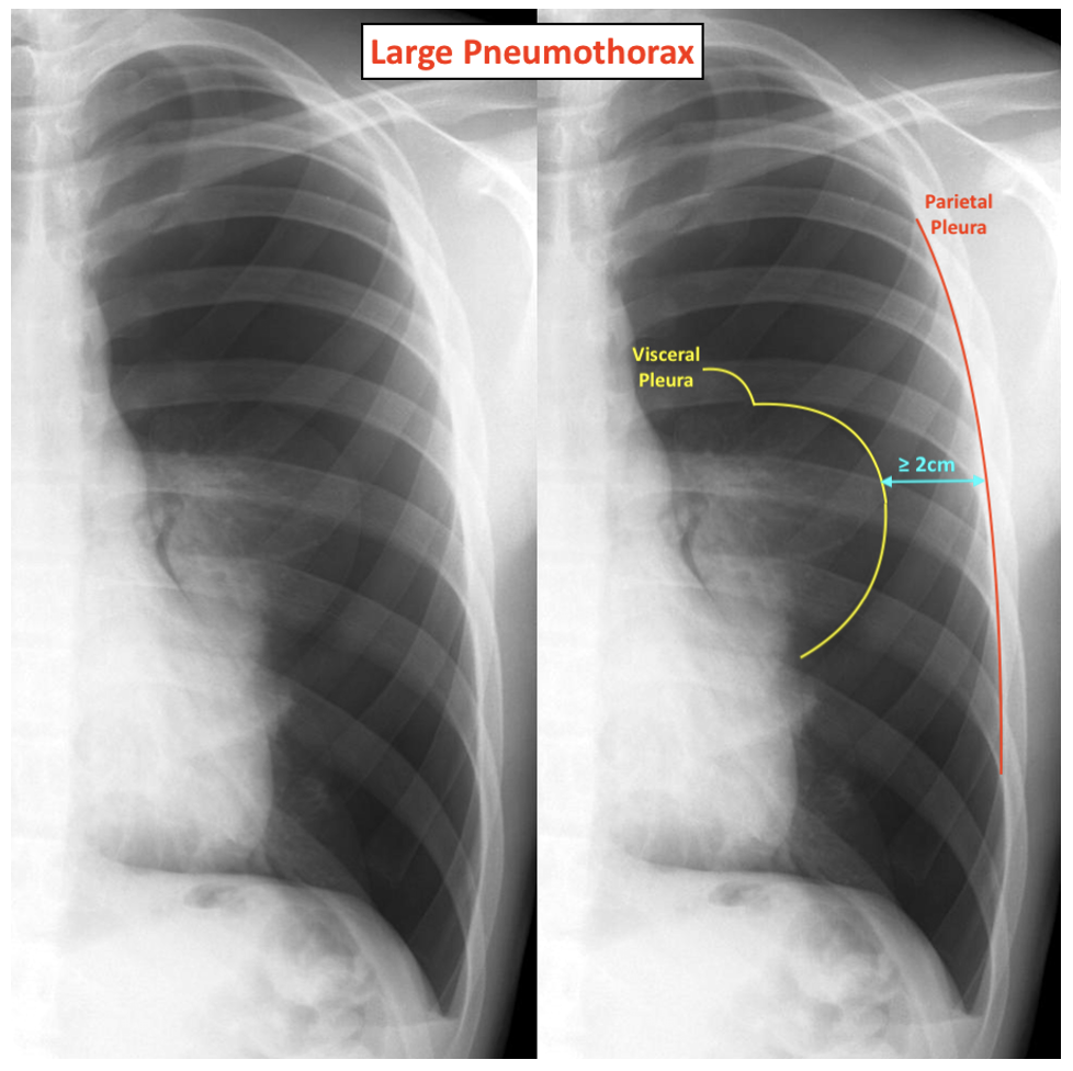 Pneumothoraces On CXR